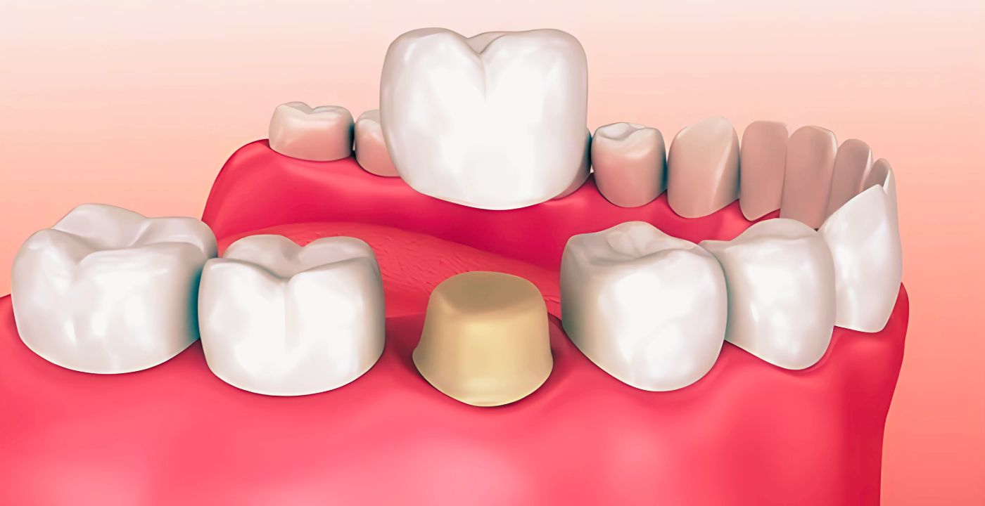dental crown