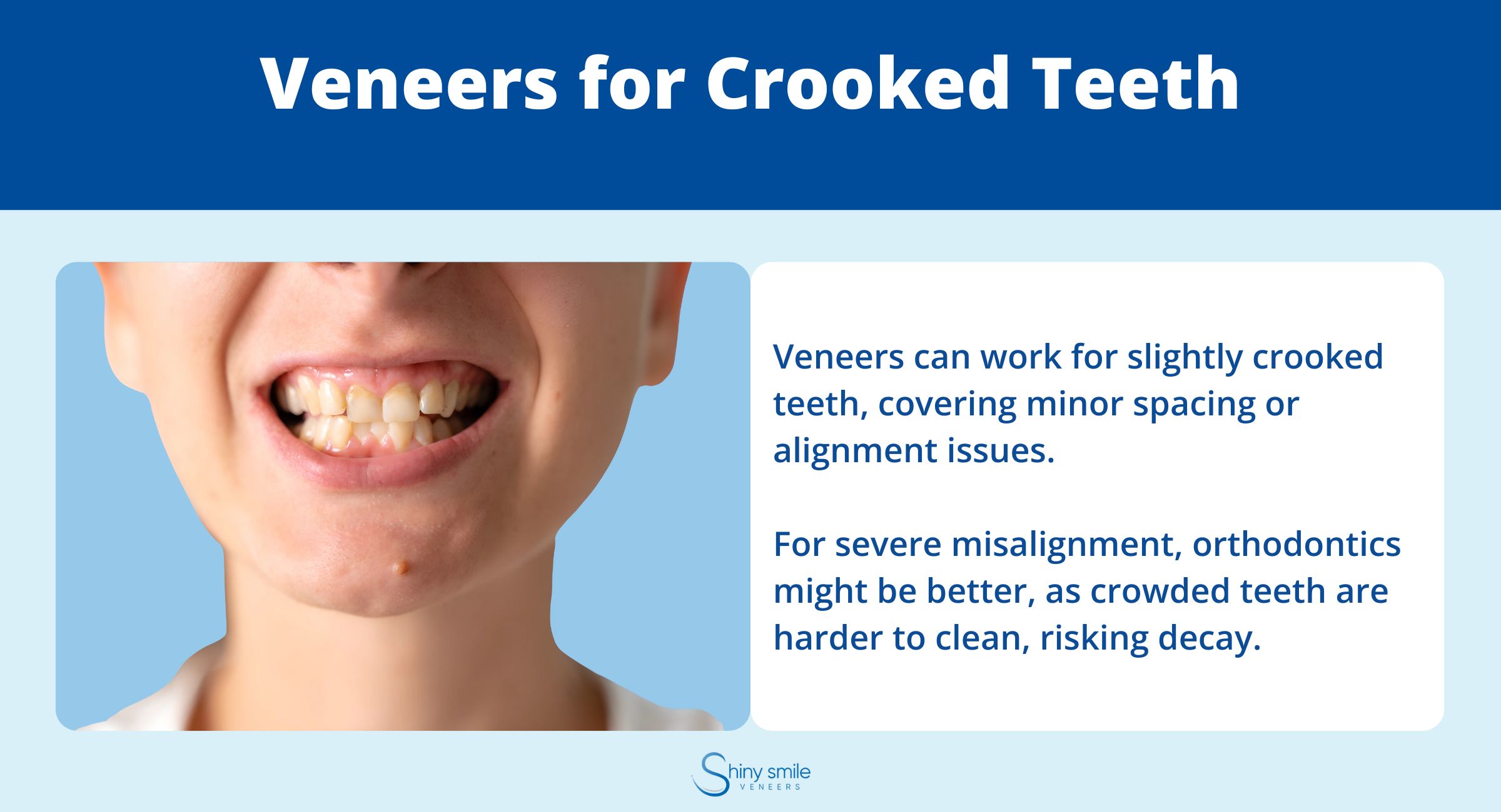 Veneers for Crooked Teeth