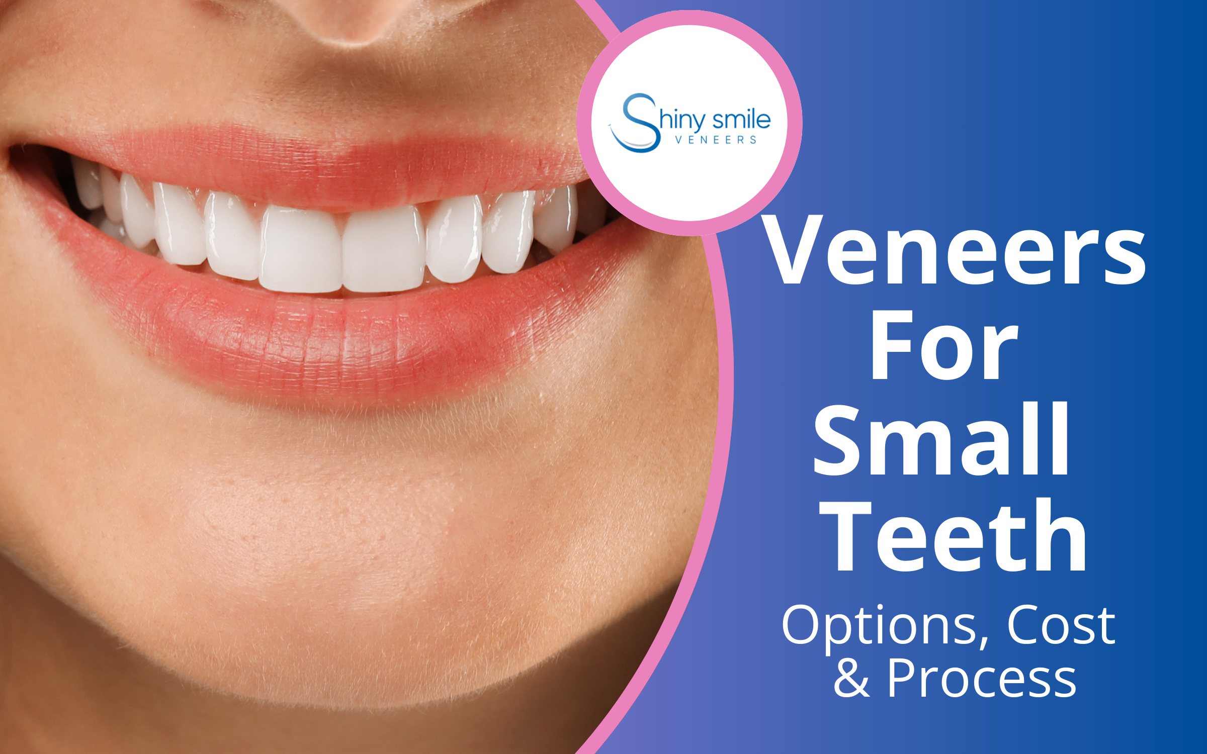 veneers for small teeth