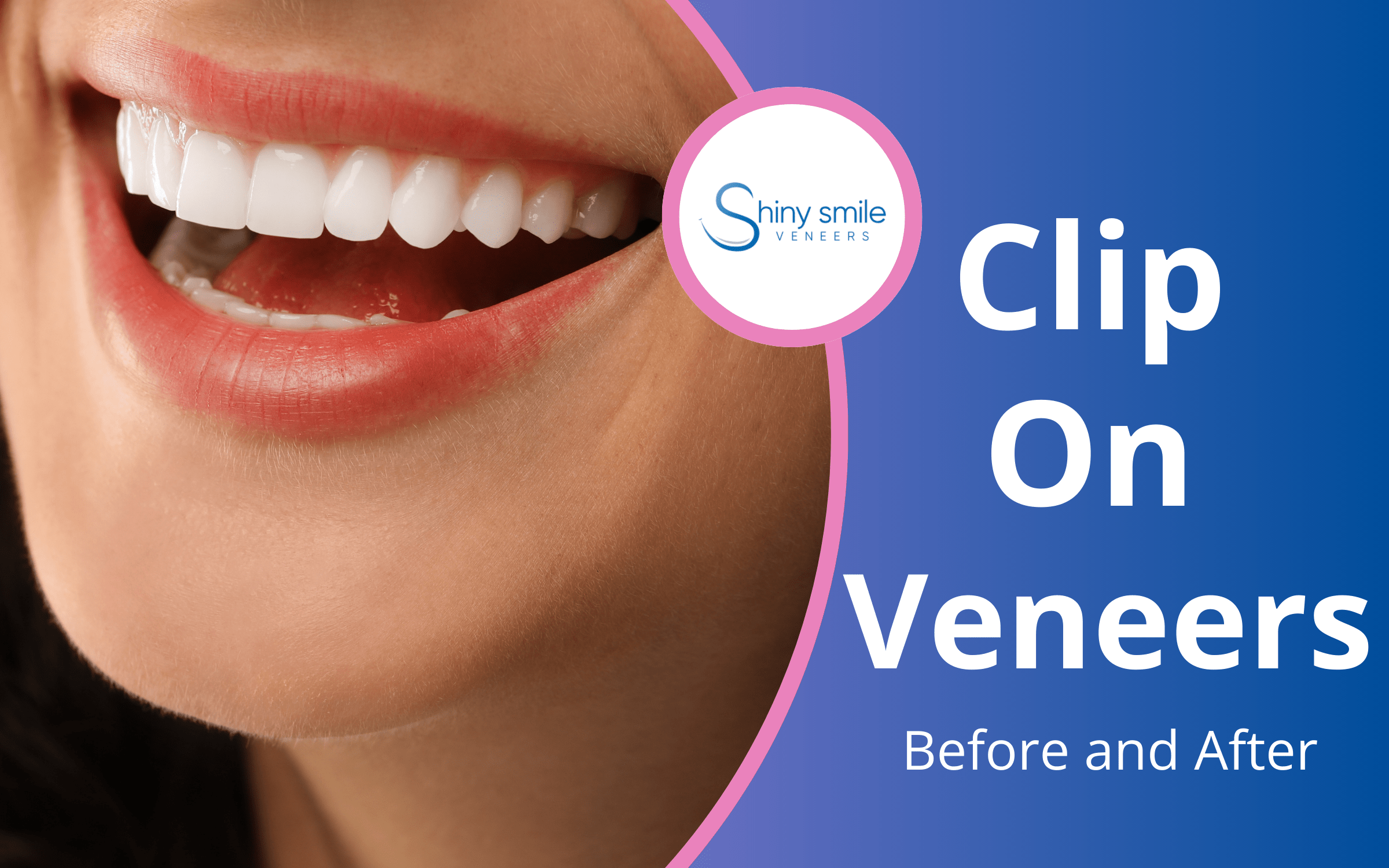 clip on veneers